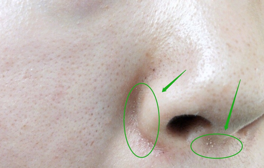 鼻子两侧的小疙瘩下巴的白米粒是闭口粉刺还是毛周角化症