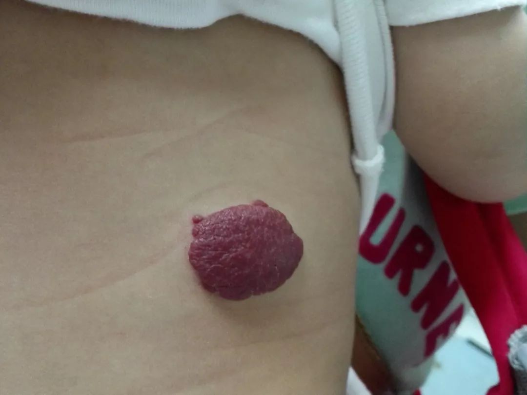 学点医丨宝宝皮肤长了血管瘤怎么办?