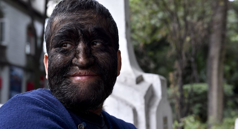 西班牙16名儿童在太阳海岸一家医院接受治疗后出现了"狼人症"的症状