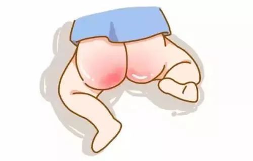 把尿脱肛,用纸尿裤致红屁股?那是你不会这几招!_宝宝