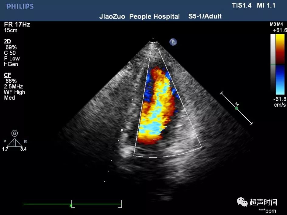 二尖瓣瓣叶分区超声图片