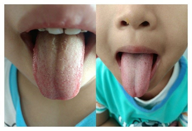 小孩肺热舌苔图片图片