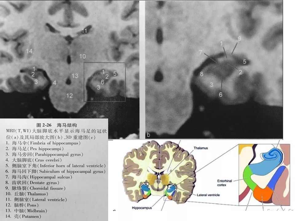 核磁共振海马解剖图图片