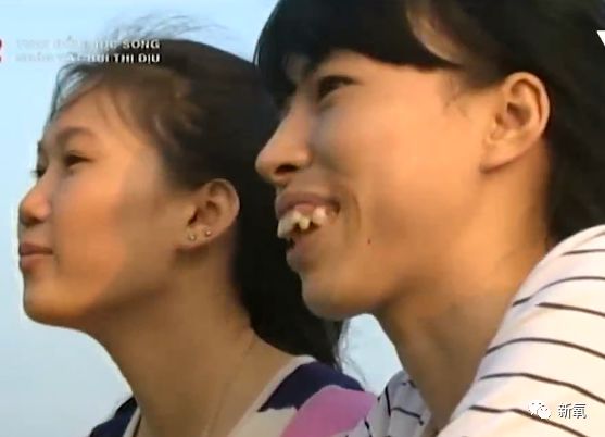 嘴凸到合不拢丑到被排斥的她如今整成完美混血脸美过昆凌