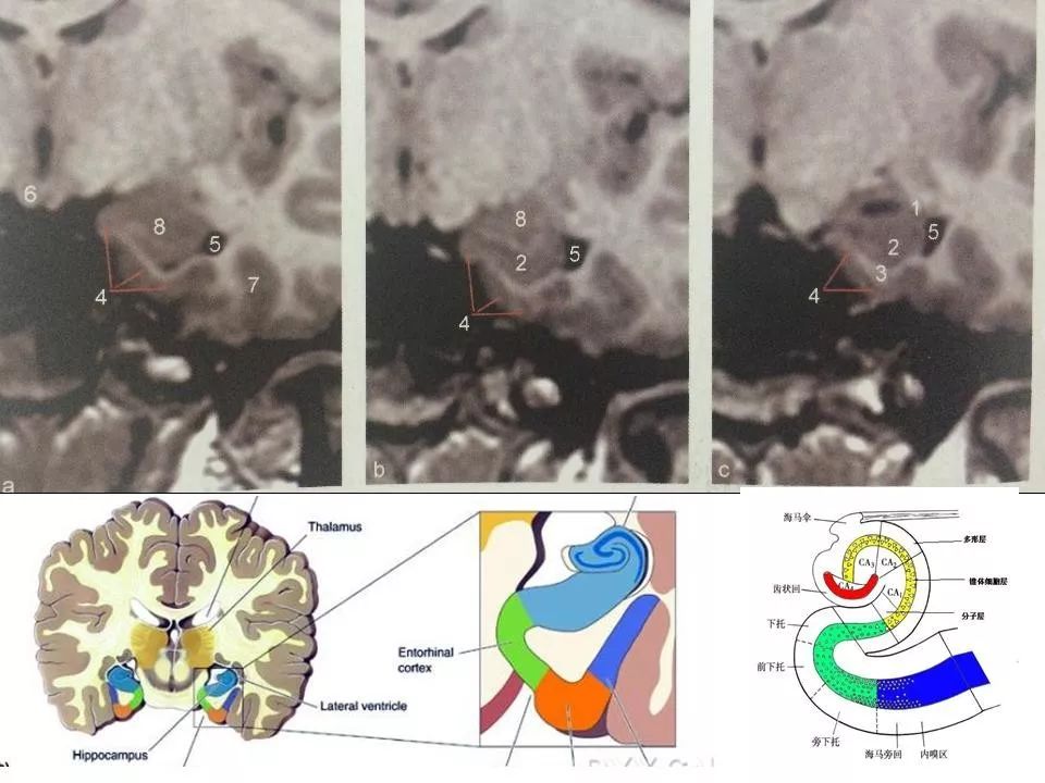 海马区CT解剖图片