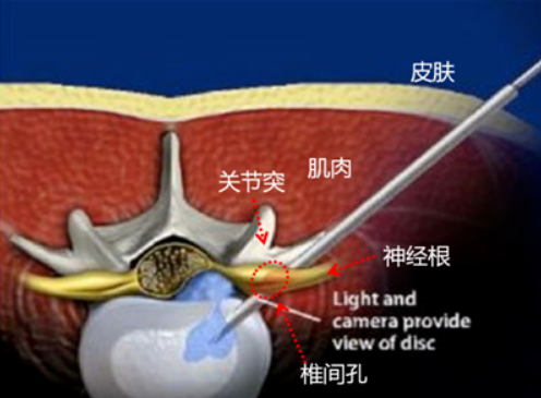 椎间孔挤压分离试验图片