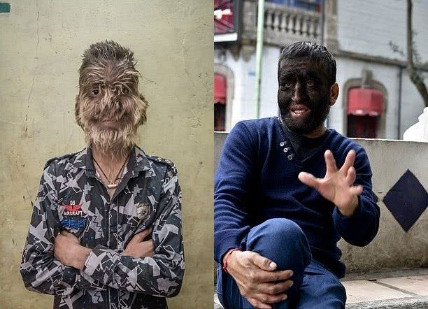 西班牙16个婴儿被传染患上"狼人综合征",原因令人气愤!