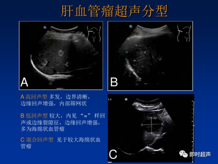 肝臟腫瘤的超聲診斷
