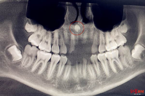 13岁男孩牙齿倒起长逆流而上差点冲进鼻子