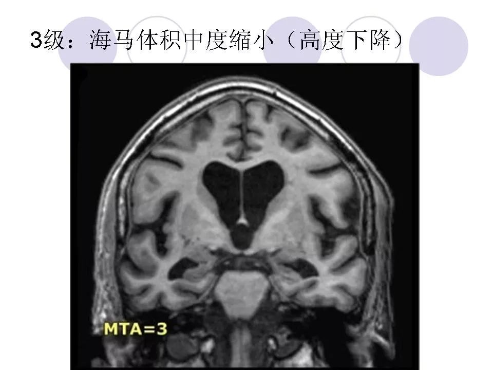 头颅磁共振海马解剖图图片