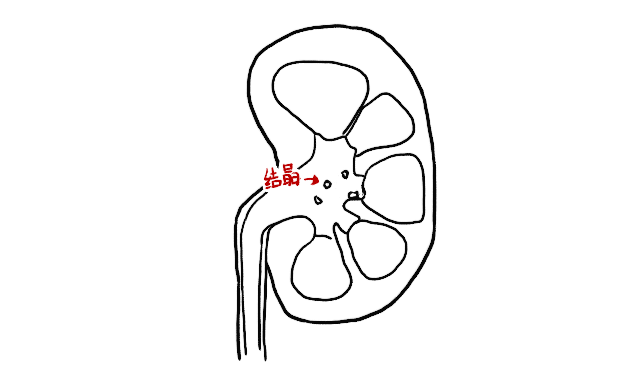 少,无法容纳的草酸钙就被沉积出来变成"结晶",越积越多就成了"结石"