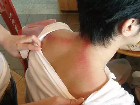 刮痧治感冒感冒,头痛,发热畏风,四肢乏力,身体困重酸麻,刮痧是治疗此