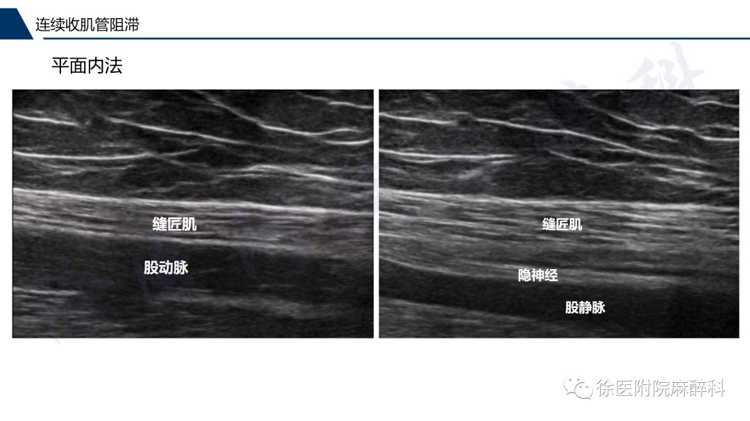 超声引导下连续收肌管阻滞