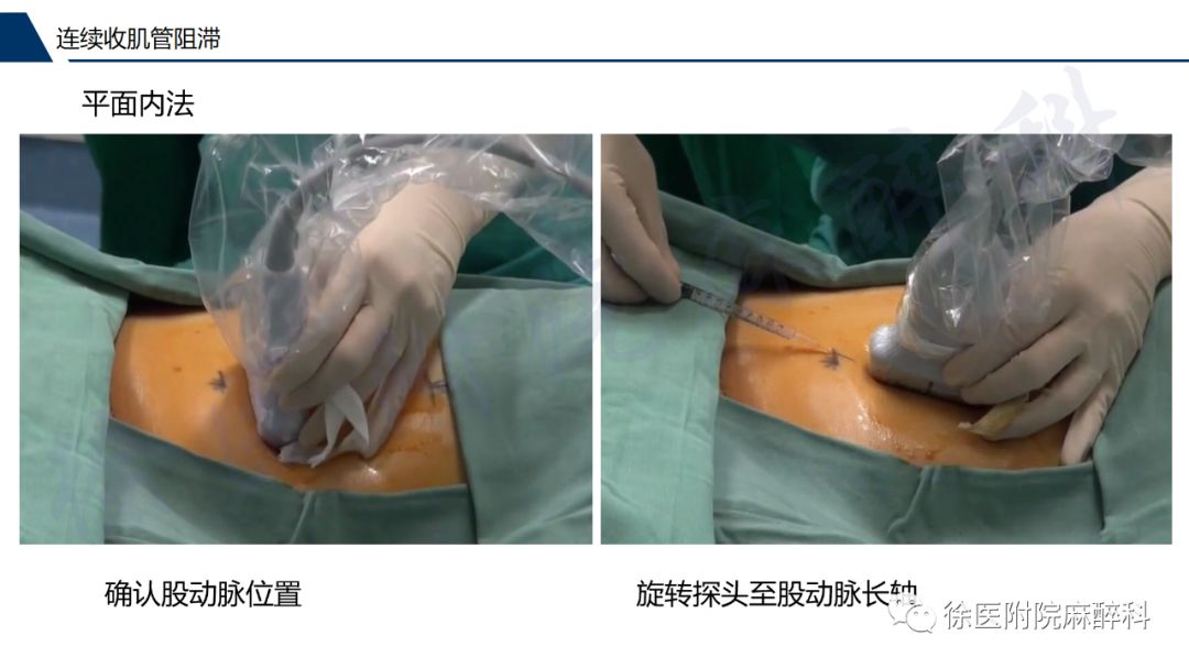 超声引导下连续收肌管阻滞