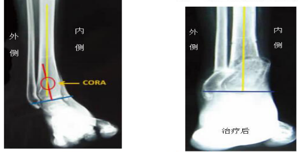 踝關節x線片正位片表現為脛骨遠端關節面內翻, 側位多伴有畸形可以