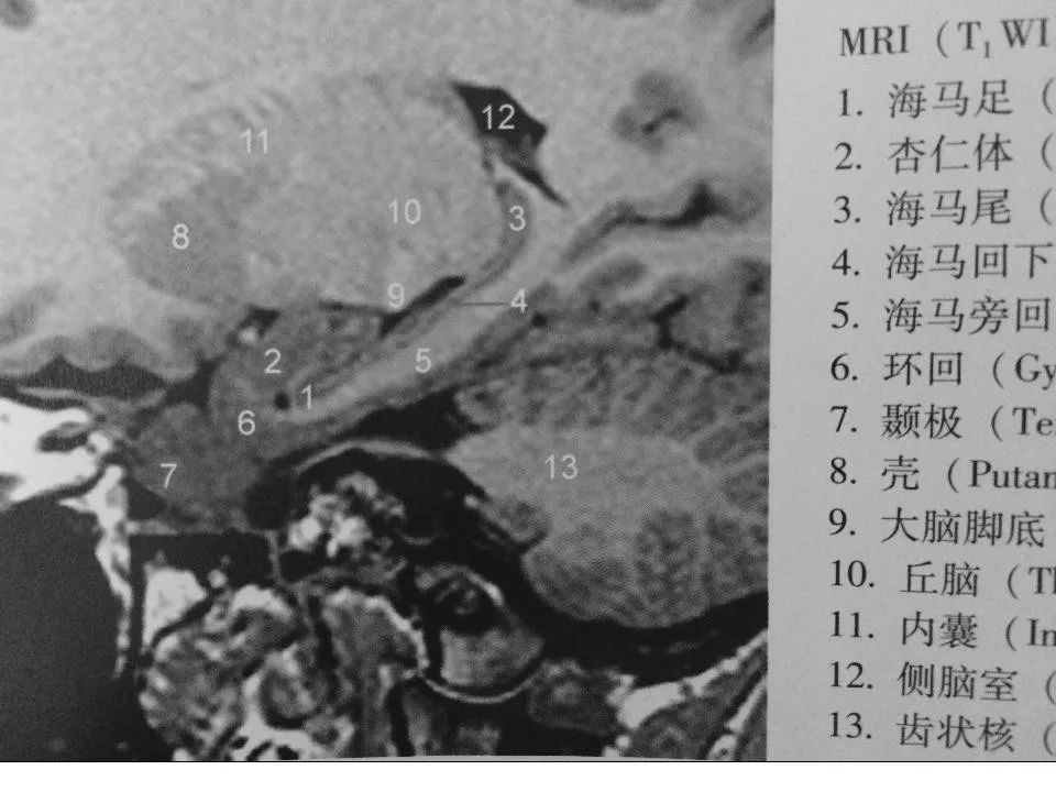 核磁共振海马解剖图图片