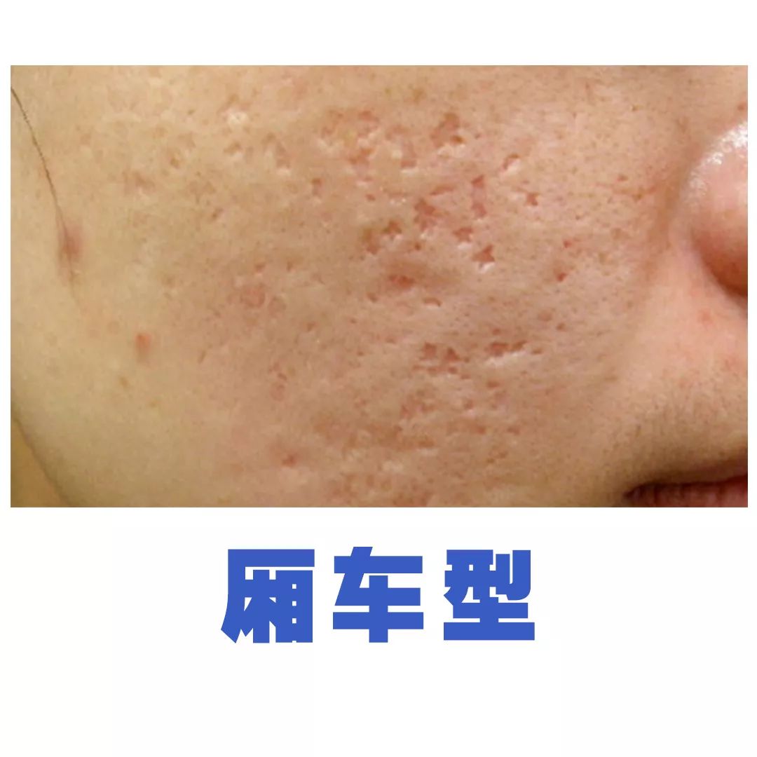 对不同类型的痘印有天壤之别,比如上图中我的碾压型痘印一次就消除了
