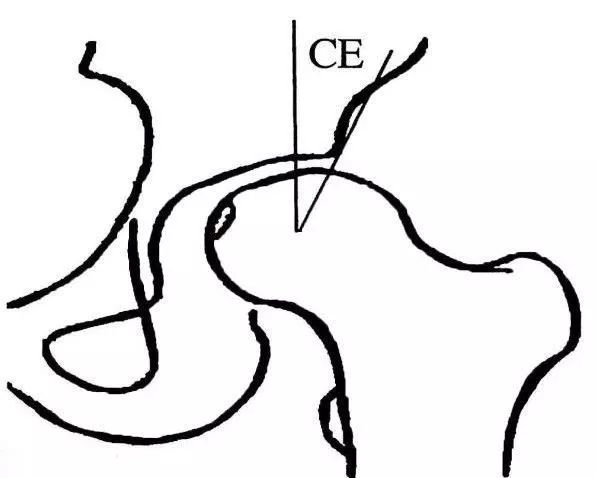 髋关节ce角测量示意图图片