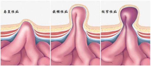 女人腹股沟疝气图片集图片