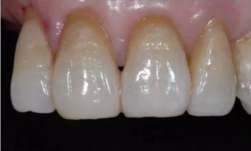 图11 右上侧切颈部颜色(没有制备洞斜面)图12 颜色仿生完成四,楔缺的