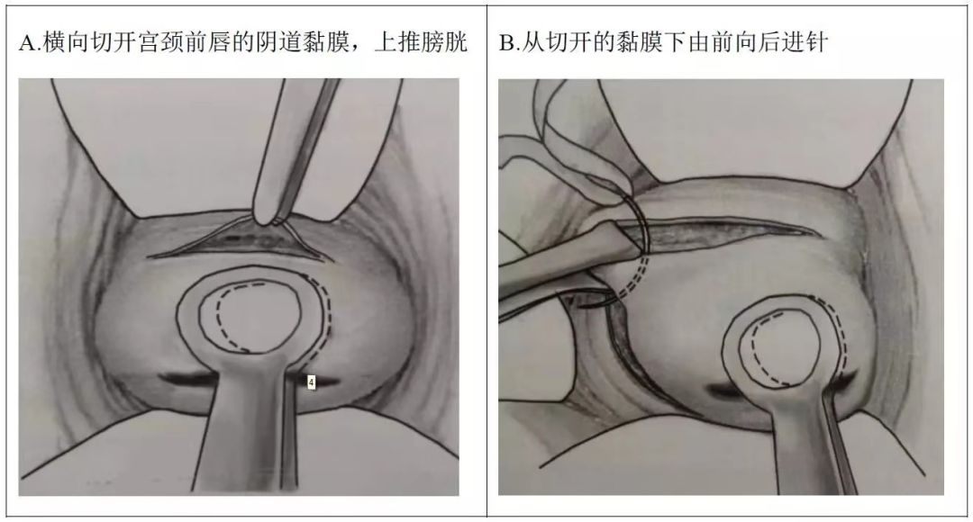 图解妇产实用技能妊娠期宫颈环扎你掌握了吗