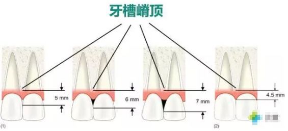 接触点到牙槽嵴顶之间的垂直距离,是决定黑三角程度的重要因素