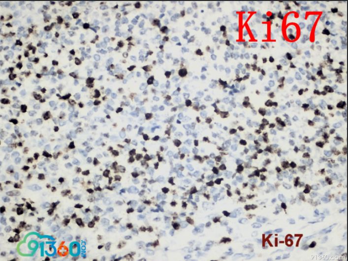 sma,calponin,cd20,syn,ck,cd34,cga,p63阳性:myod1,myogenin,cd56