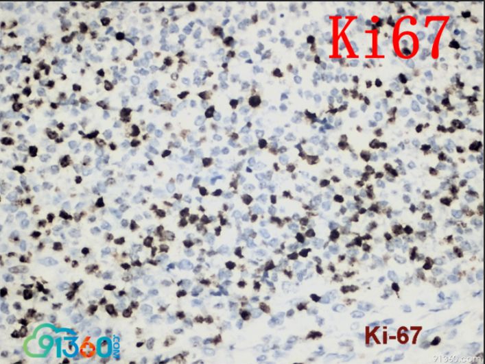 ki67组化图片