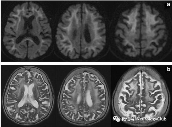 神经综述神经元核内包涵体病的研究进展