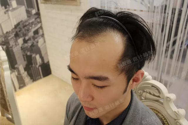 27岁大m秃植发3487单位1年后悄然逆袭