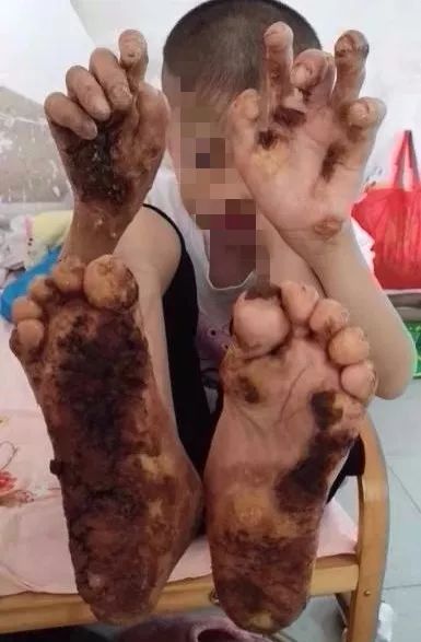 广西15岁少年患树人怪病,手脚长出树皮状硬块,上海专家:还有希望