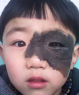 黑毛痣是一种什么病我们应该如何治疗黑毛痣呢?