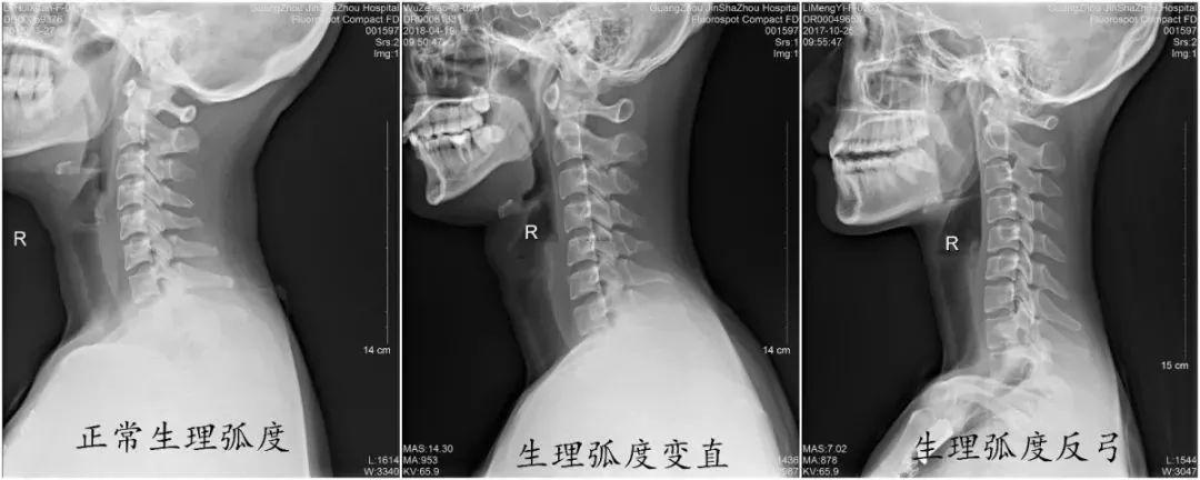 颈椎曲度变直对比图片