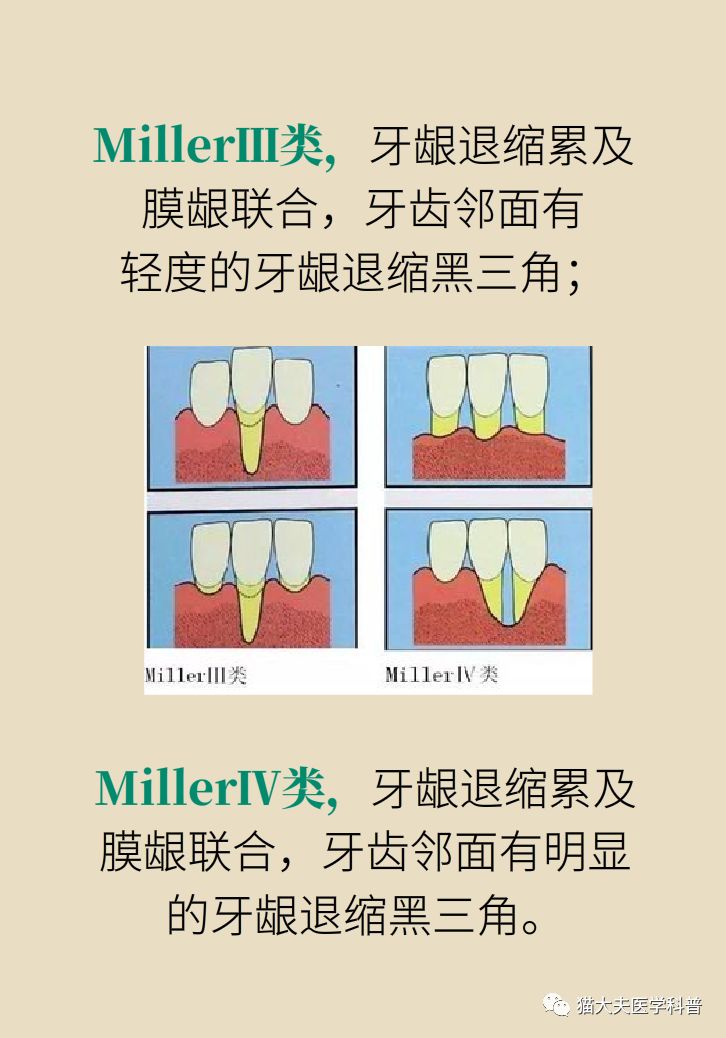 膜龈联合界图片