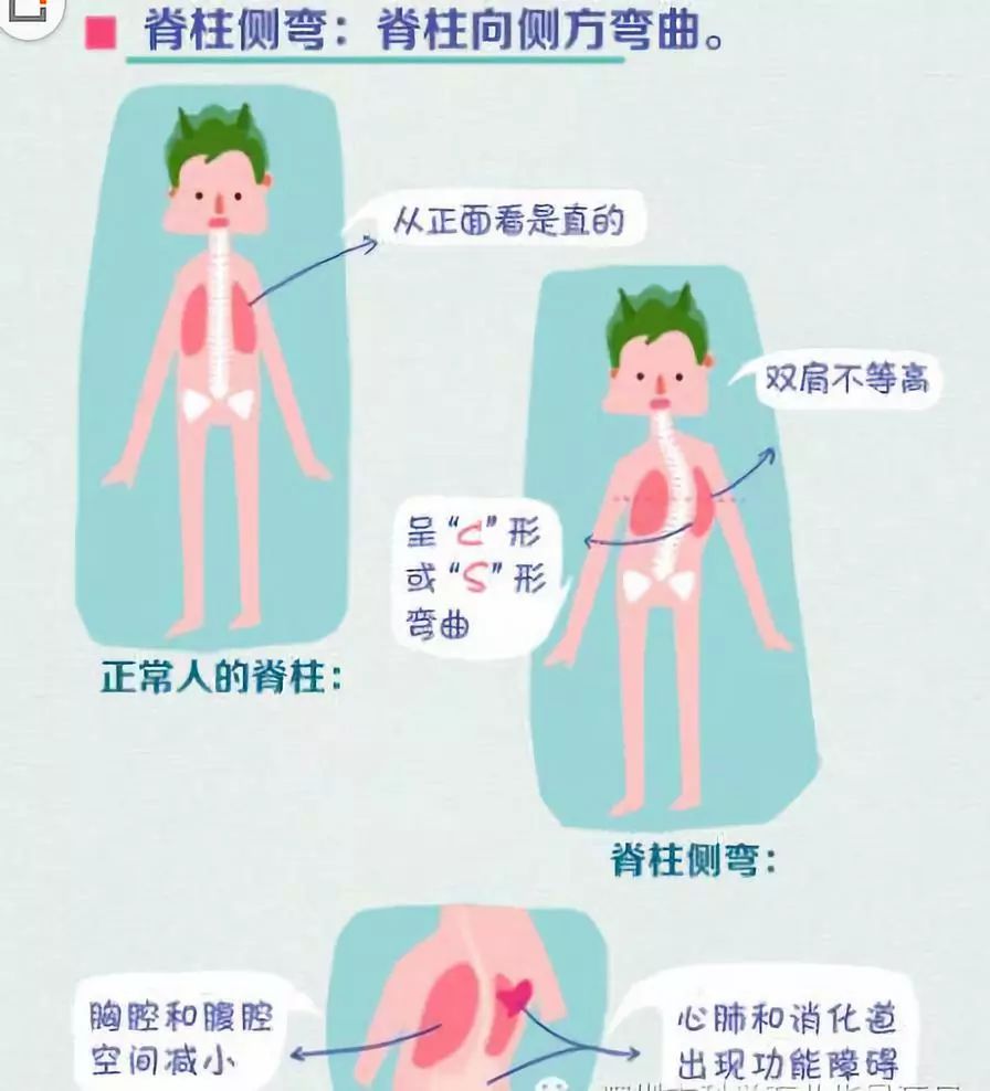 腿一长一短肩膀一高一低很可能是这个病