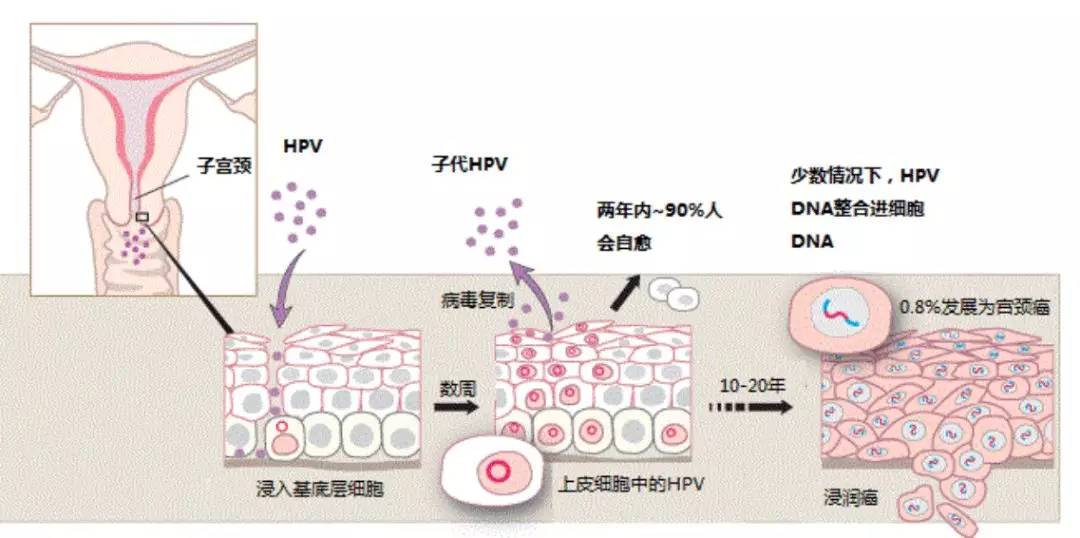 过程 宫颈癌是怎样一步一步形成的?