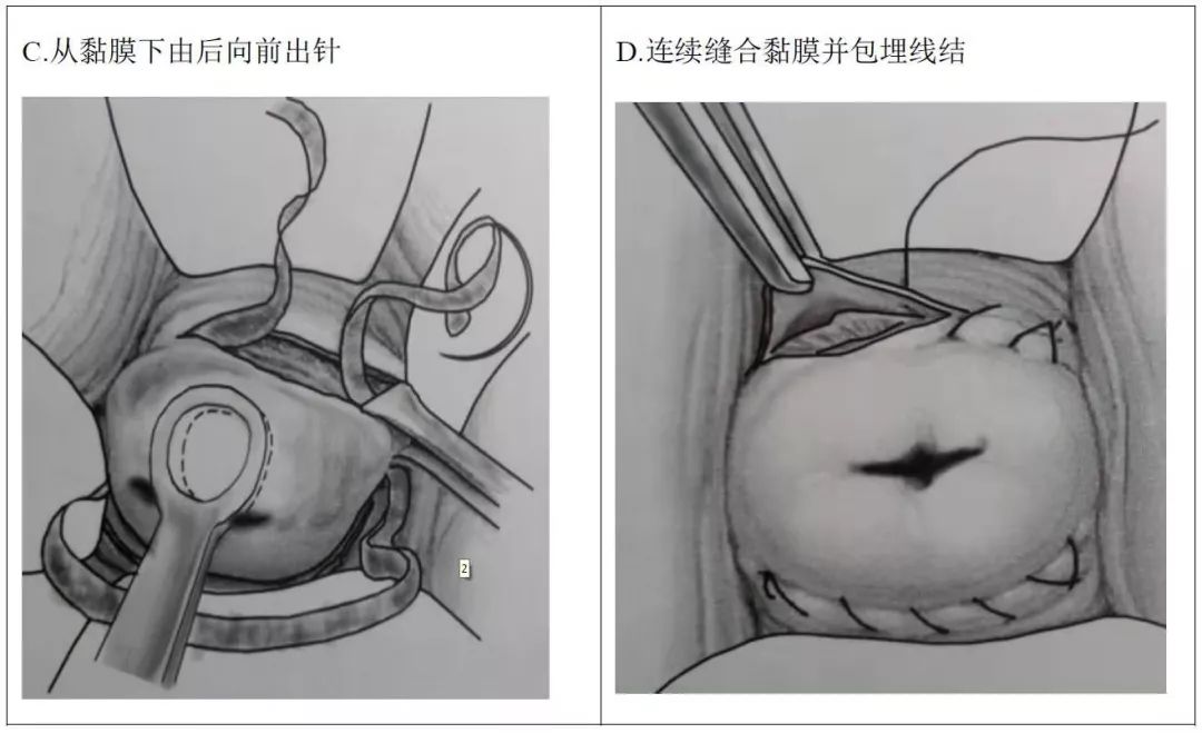 宫颈环扎后分泌物图片图片
