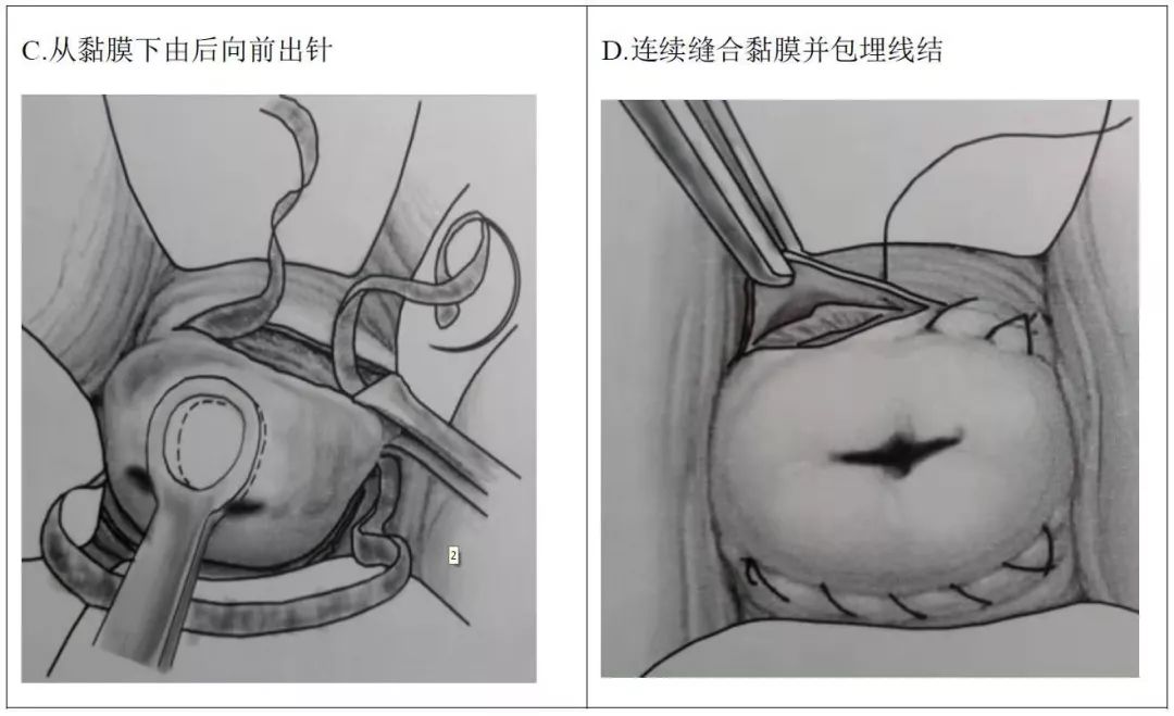 拆除的宫颈环扎线图片图片