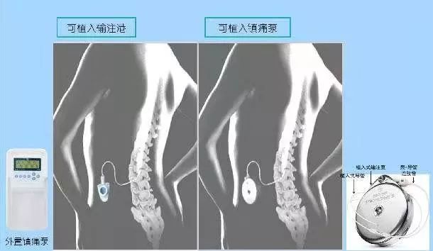 纳布啡静脉镇痛泵用量图片