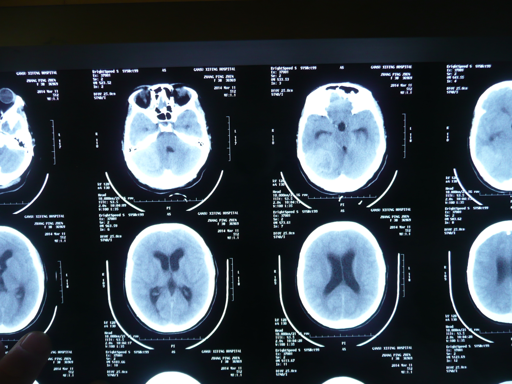 贺晓生教授小脑幕上下骑跨脑膜瘤的外科切除手术案例