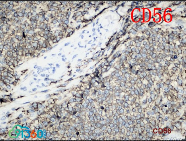 sma,calponin,cd20,syn,ck,cd34,cga,p63阳性:myod1,myogenin,cd56