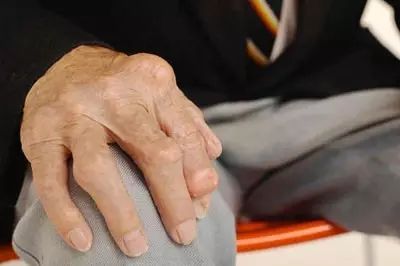 从关节疼痛特点判断是否为类风湿性关节炎