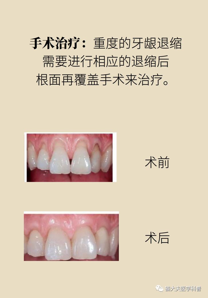 牙根暴露不敢刷牙终于有治疗的新方法了