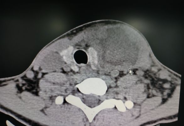 丁香病例咽痛8天颈部脓肿一查原来是人鱼女孩