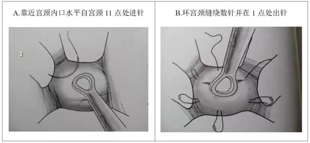 宫颈环扎术图解图片