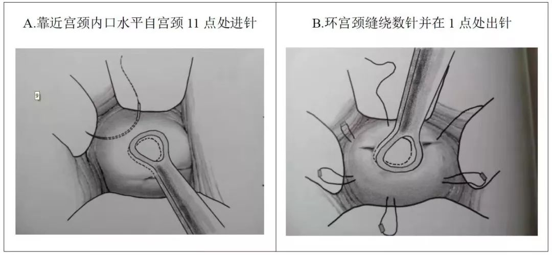 紧急宫颈环扎术图片