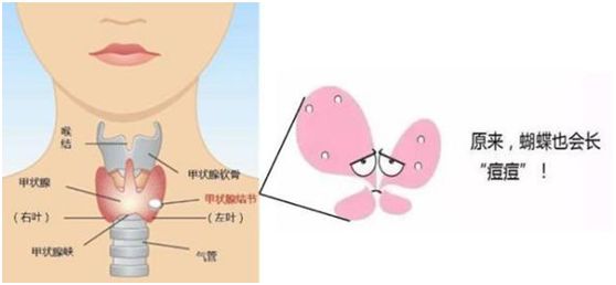 担心甲状腺结节癌变先做穿刺活检无痛又安全