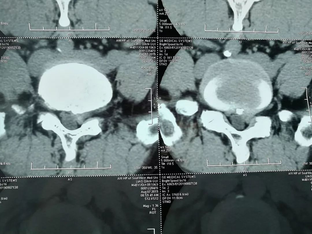 ct示:腰椎骨质增生;l3~s1椎间盘膨出,l5/s1椎间盘左侧旁中央突出患者