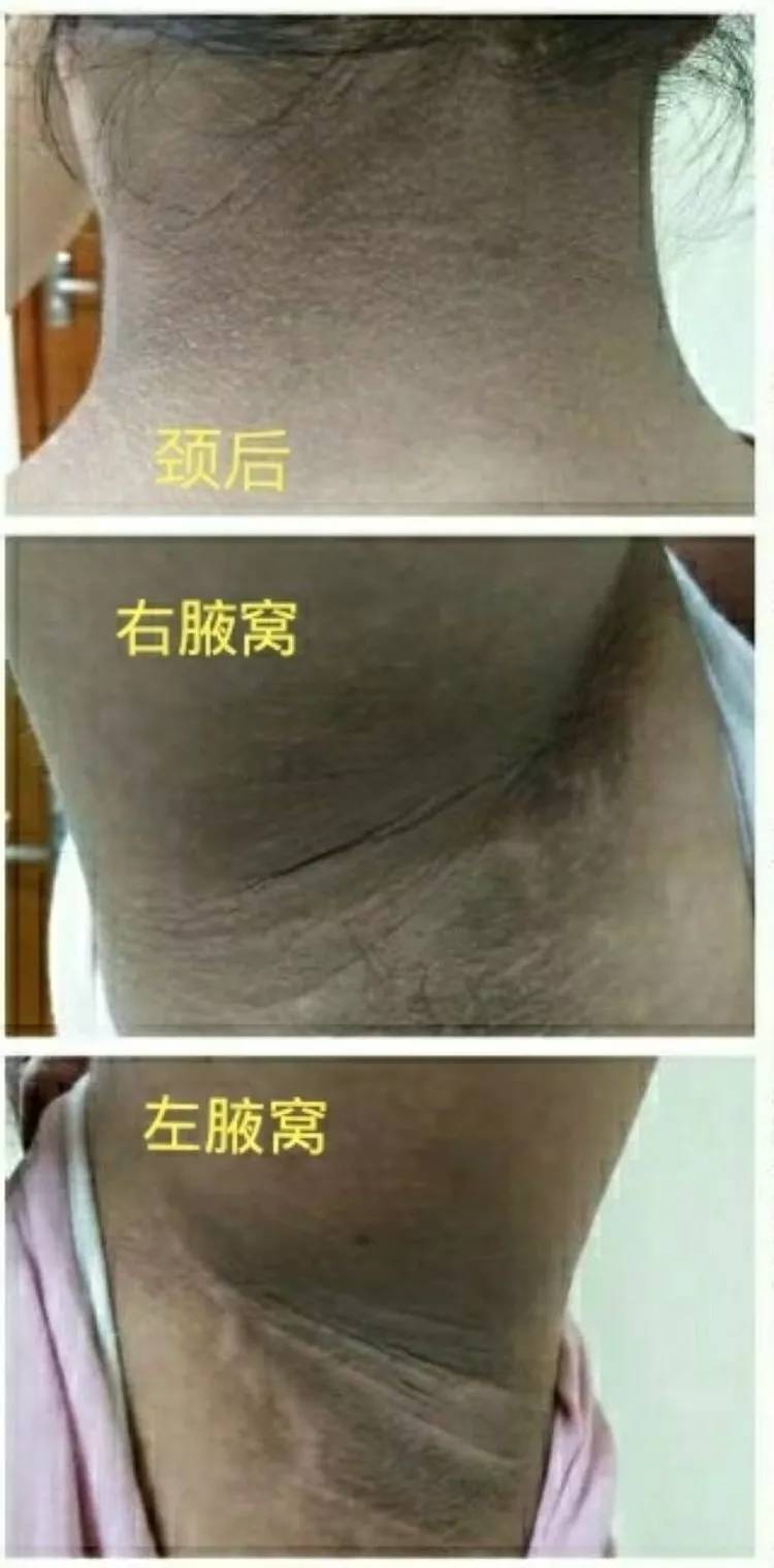 孩子脖子发黑总洗不干净