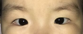 患儿内眦赘皮,遮住鼻侧球结膜,外观呈内斜视,但角膜映光点正位,交替